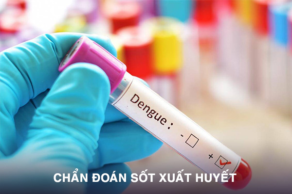 Chẩn đoán sốt xuất huyết