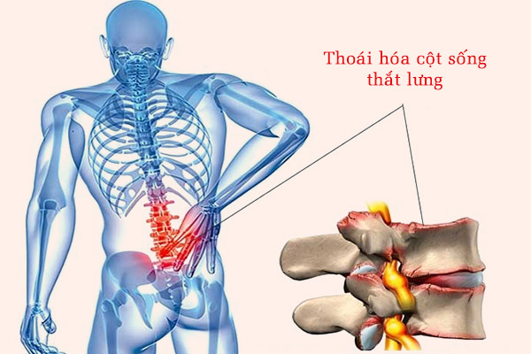 Thoái hóa cột sống thắt lưng có thể gây chèn ép rễ thần kinh