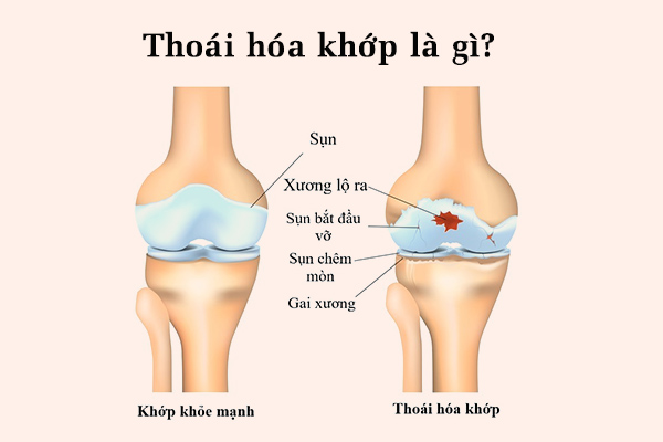 Thoái hóa khớp là bệnh gì?