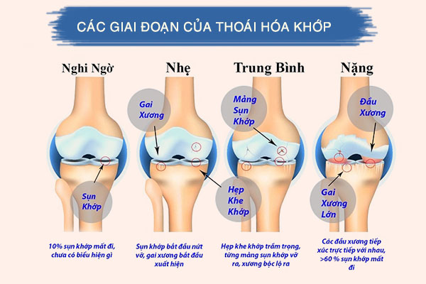 Các giai đoạn của thoái hóa khớp