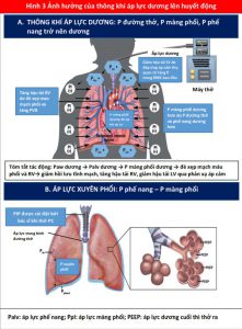 Hình 3 Ảnh hưởng của thông khí áp lực dương lên huyết động