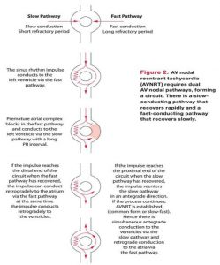 Hình 2: AVNRT đòi hỏi phải có 2 con đường bên trong nút nhĩ thất. Đấy là đường dẫn truyền chậm có thời gian phục hồi nhanh và đường dẫn truyền nhanh có thời gian hồi phục chậm.