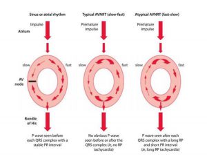 Hình 3: AVNRT điển hình và không điển hình.