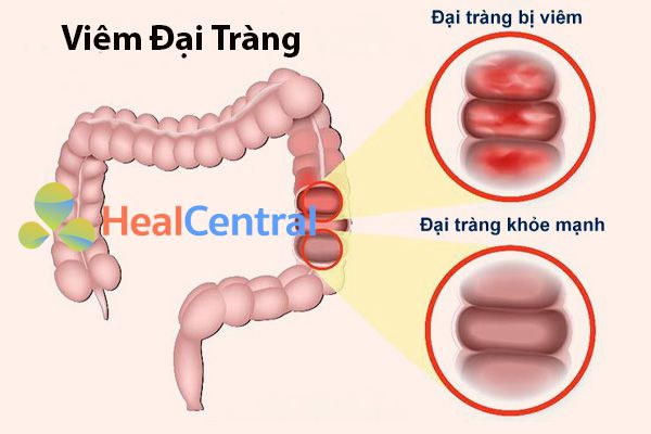 àng phục linh sử dụng trong một số trường hợp như viêm đại tràng cấp và mãn tính.