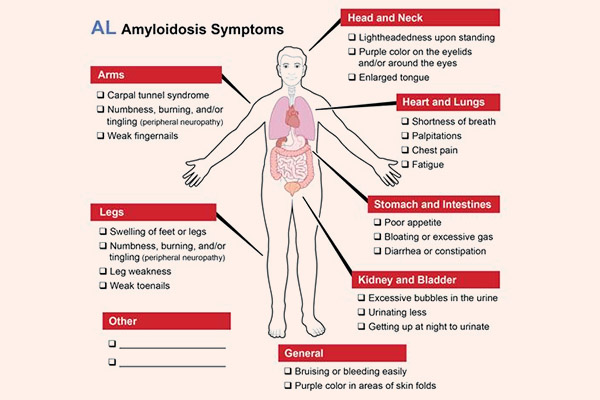 Triệu chứng của AL Amyloidosis
