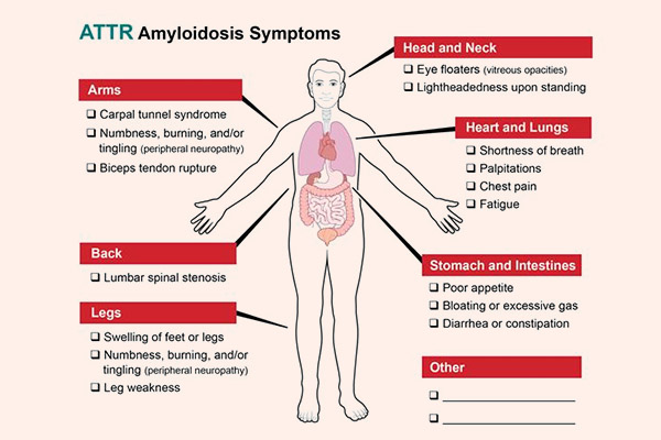 Triệu chứng của ATTR Amyloidosis