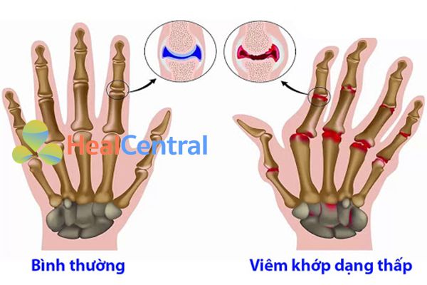 Ảnh: Viêm khớp dạng thấp