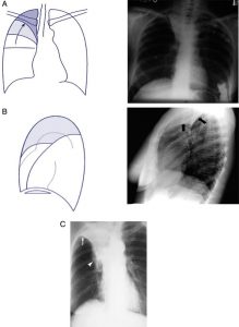 Hình 3. (A) Xẹp RUL (hình sau-trước). Các rãnh liên thùy nhỏ và rốn phổi được di chuyển lên trên. Đường viền trung thất bị che khuất. Khí quản bị lệch sang phải. (B) xẹp RUL (hình nghiêng bên). Các rãnh liên thùy nhỏ và lớn (mũi tên) được kéo lên trên gây ra hình mờ hình tam giác với các lề được xác định rõ. (C) Dấu hiệu Golden S. Điều này được thấy trong xẹp RUL do một tổn thương hàng loạt. Phần cao hơn của chữ ‘S’ là từ rãnh liên thùy nhỏ bị dịch chuyển (mũi tên), trong khi phần thấp hơn là kết quả của chính khối xẹp đó (đầu mũi tên).