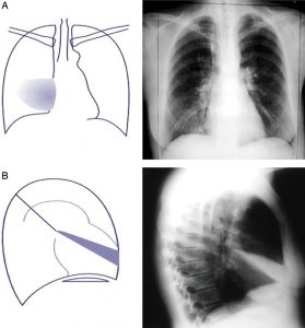 Hình 4. (A) Xẹp RML (hình sau-trước). Rãnh liên thùy nhỏ bị dịch chuyển xuống dưới. Có một hình mờ không xác định liền kề với đường viền tim phải và mất đường viền tim phải. (B) Xẹp RML (hình nghiêng bên). Có một hình mờ đục hình nêm kéo dài từ rốn phổi.