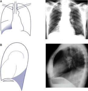 Hình 5. (A) Xẹp RLL (hình sau-trước). Có một hình mờ được xác định rõ ở giáp ranh giới tim bên phải với sự mất hình ảnh của cơ hoành bên phải. Đường viền trái tim bên phải vẫn nhìn thấy được. (B) xẹp RLL (hình nghiêng bên). Có một hình mờ phía sau được xác định rõ, với rãnh liên thùy xiên bị dịch chuyển. Mất sự sẫm màu bình thường của các thân đốt sống ngực.