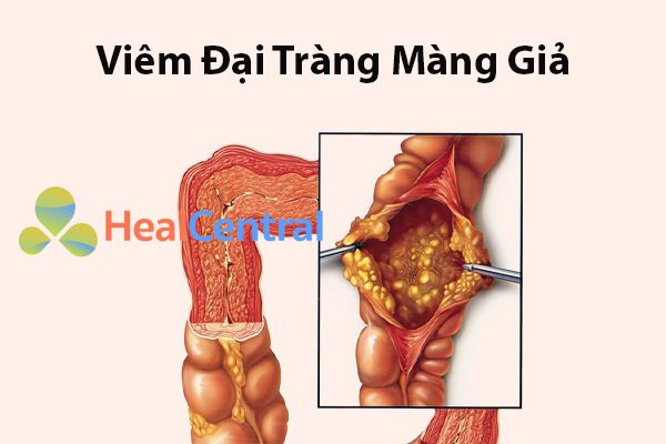 Viêm đại tràng màng giả sau khi dùng Zinnat