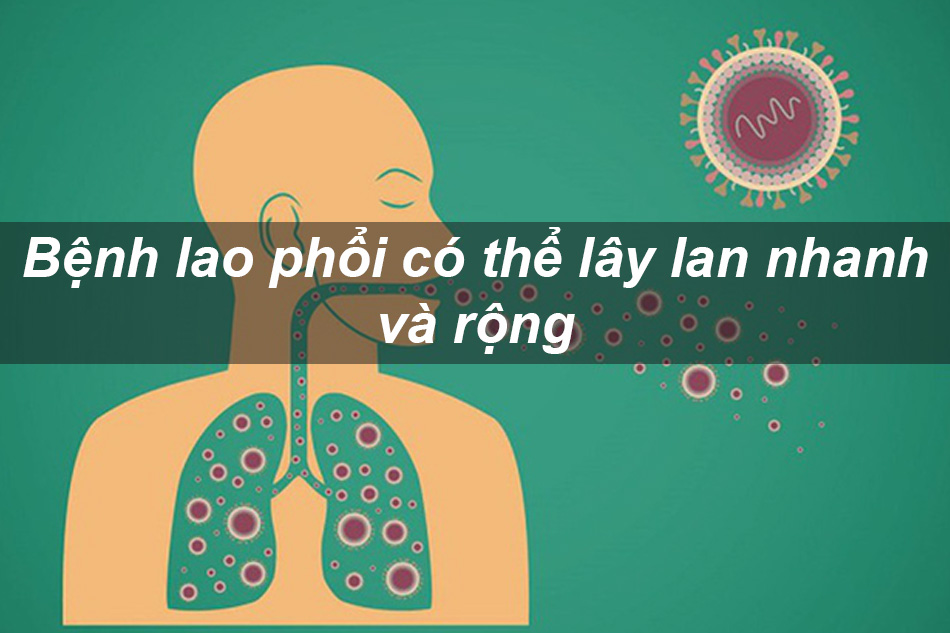 Bệnh lao phổi có tính chất lây lan rất nhanh và rộng