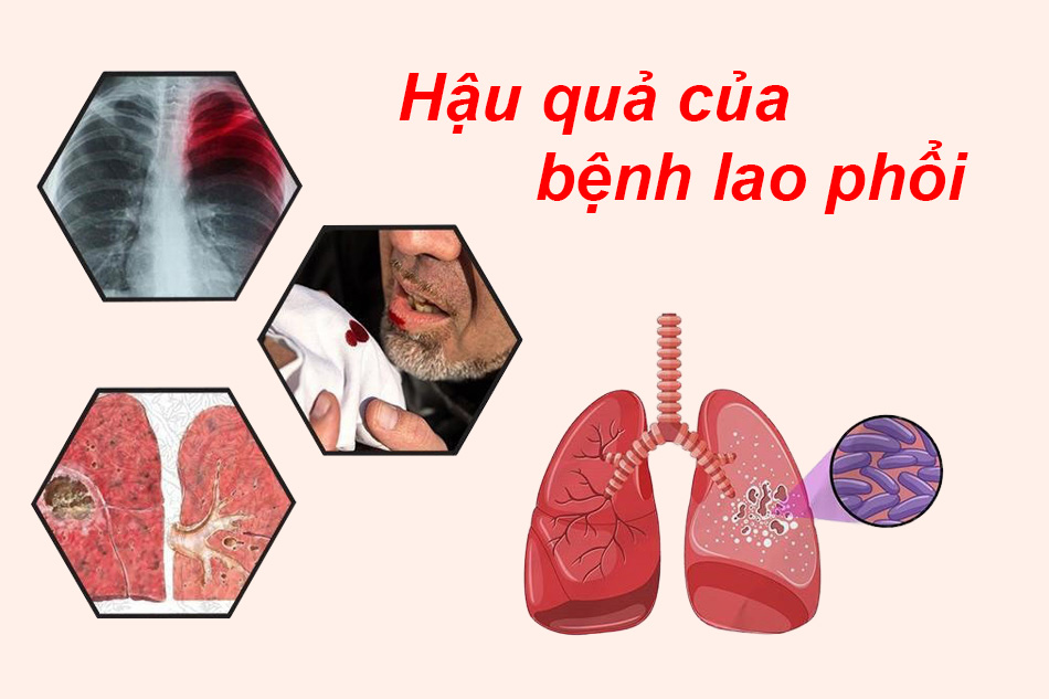 Hậu quả của bệnh lao phổi