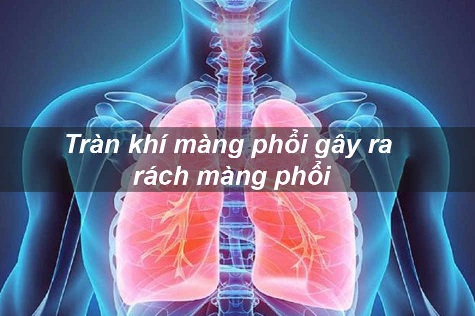 Tràn khí màng phổi gây ra rách màng phổi