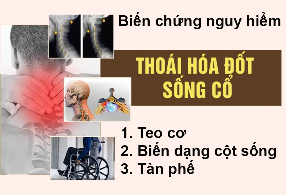 Những biến chứng thoái hóa đốt sống cổ dễ xảy ra