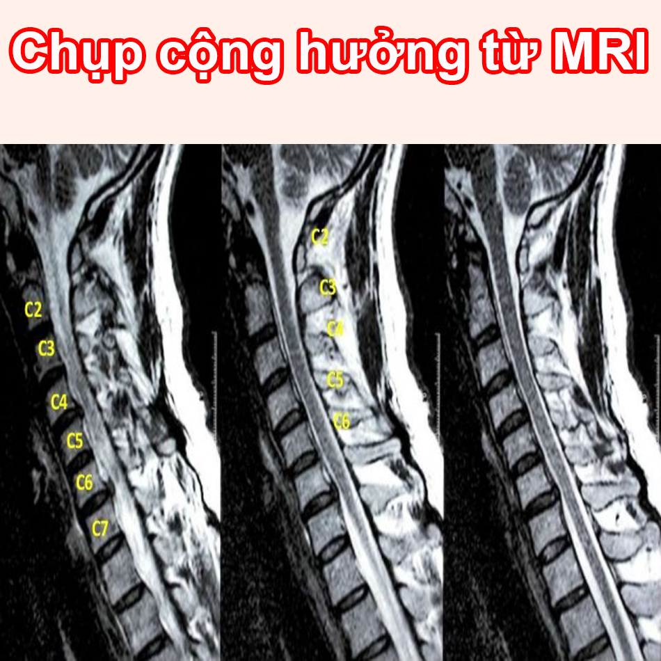 Hình ảnh chụp cộng hưởng từ MRI thoái hóa đốt sống cổ