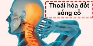 Bệnh thoái hóa đốt sống cổ: Nguyên nhân, triệu chứng và cách điều trị