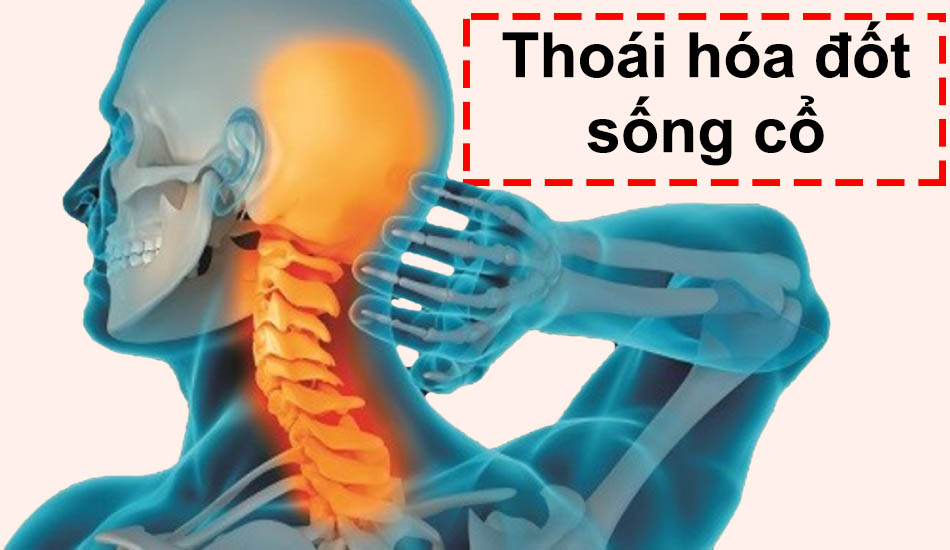Bệnh thoái hóa đốt sống cổ: Nguyên nhân, triệu chứng và cách điều trị