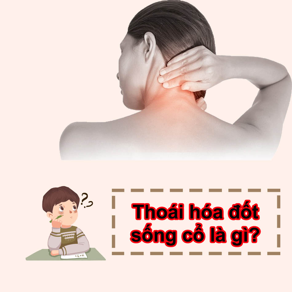 Thoái hóa đốt sống cổ là gì?