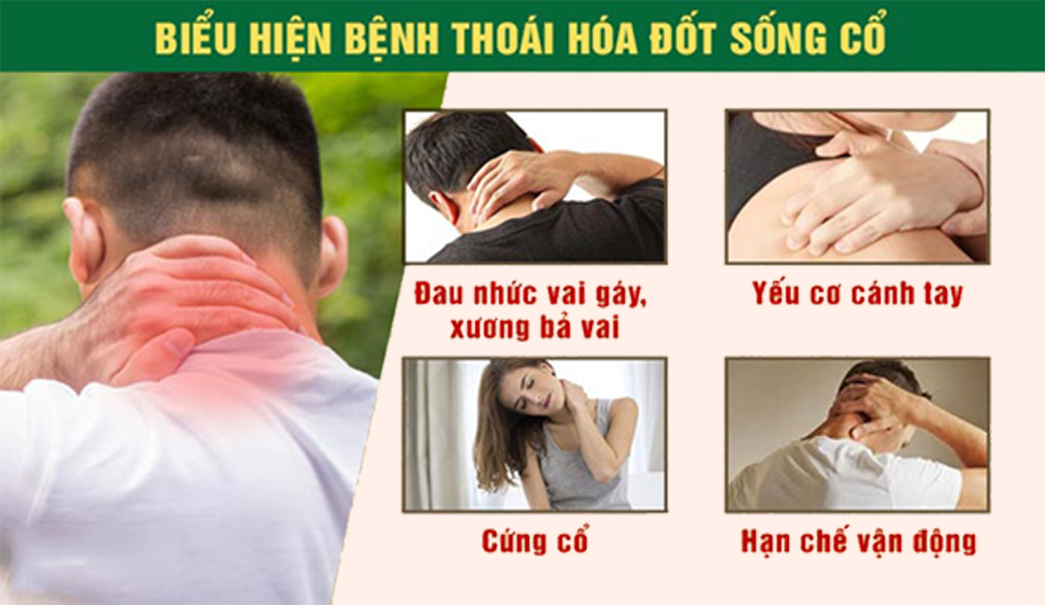 Triệu chứng cuẩ thoái hóa đốt sống cổ