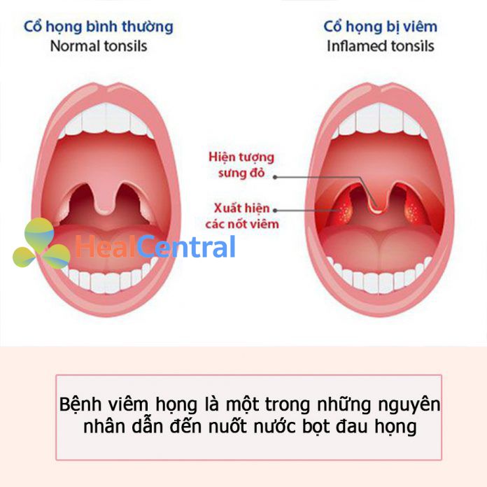 Đau cổ họng bên phải là do đâu, chữa thế nào?