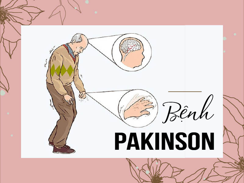 Bệnh Parkinson là gì? Nguyên nhân, triệu chứng và cách điều trị hiệu quả