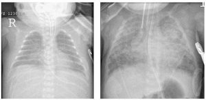 Hình 1 Trái: X-quang phổi cho thấy loạn sản phế quản phổi sớm với các trường phổi nhỏ mờ Phải: X-quang ngực cho thấy BPD thành lập với bóng kẽ lan rộng ở cả hai trường phổi, phù hợp với xơ hóa. Mất đậm độ của xương sườn phù hợp với chứng loãng xương sớm, một mối liên quan thường xuyên của chứng loạn sản phế quản phổi.
