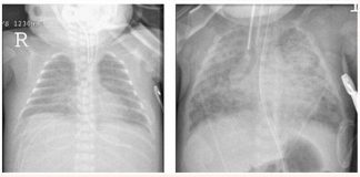 Bệnh sinh và điều trị loạn sản phế quản phổi