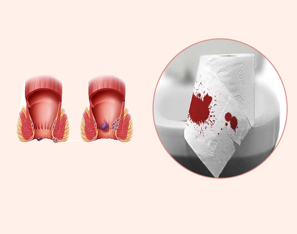 Bệnh trĩ gây đi ngoài ra máu