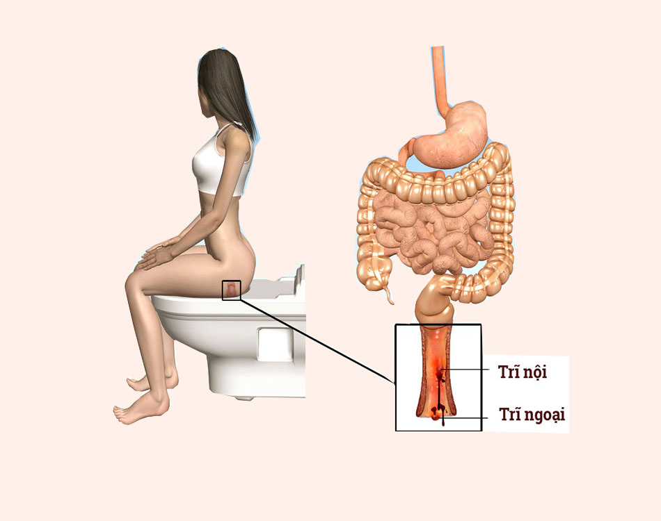 Bệnh trĩ là gì?