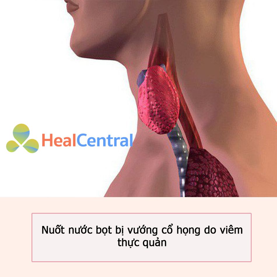 Nuốt nước bọt bị vướng cổ họng do viêm thực quản