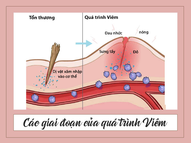 Viêm có thể chia thành 4 giai đoạn