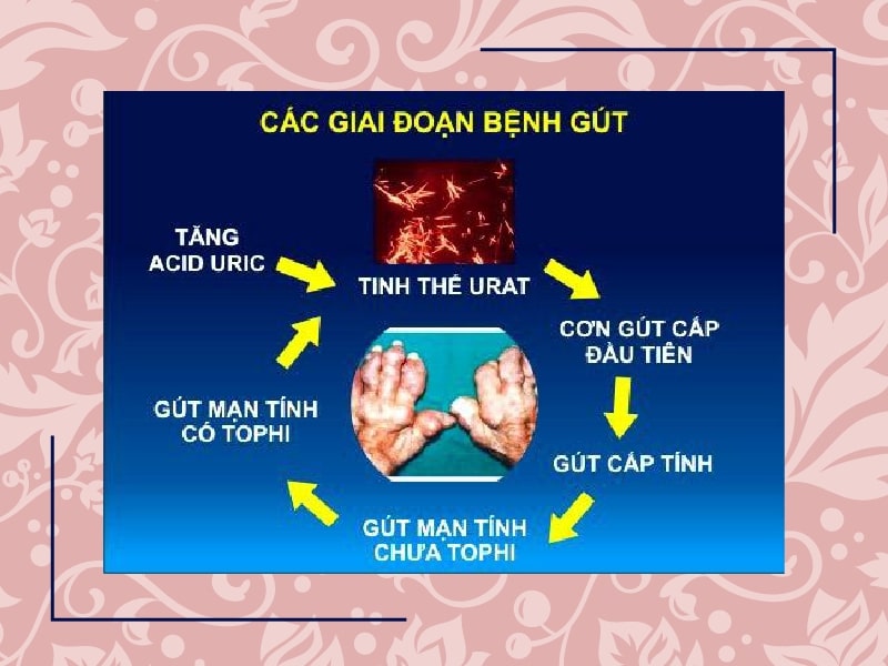 Các giai đoạn của GOUT