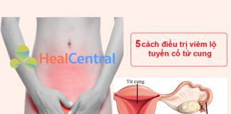 5 cách điều trị viêm lộ tuyến cổ tử cung