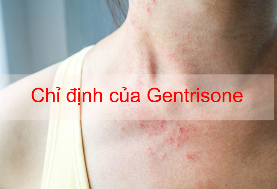 Chỉ định của Gentrisone