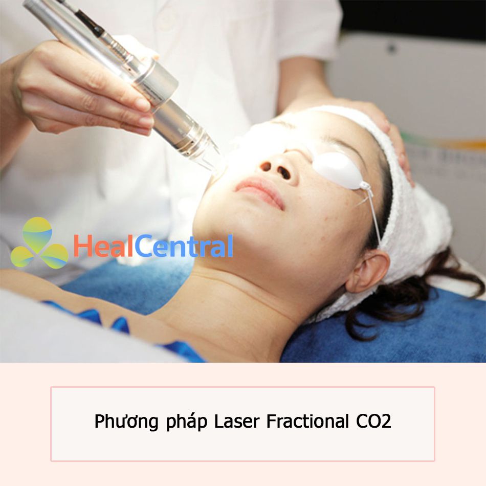 Điều trị sẹo rỗ với phương pháp Laser Fractional CO2