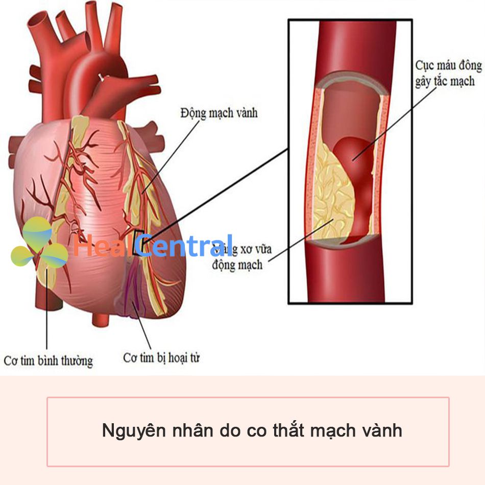 Co thắt mạch vành dẫn đến đau rức ngực