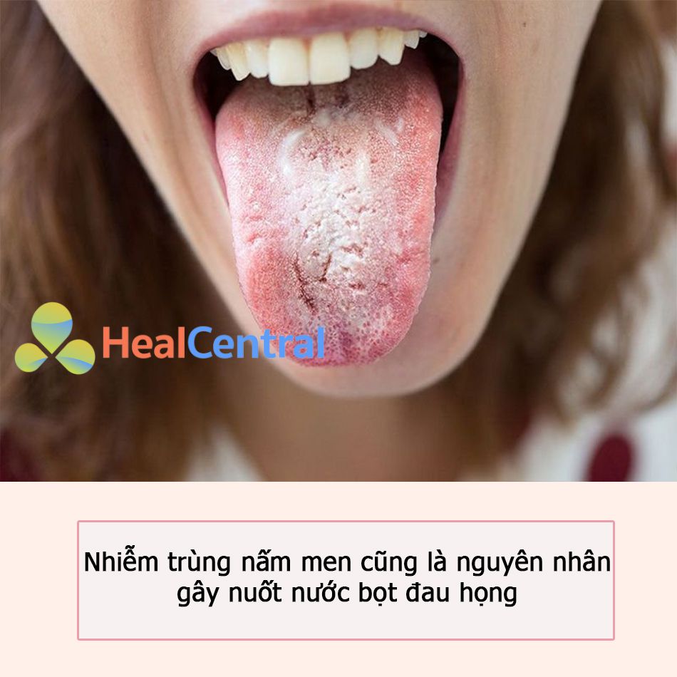 Nhiễm trùng nấm men