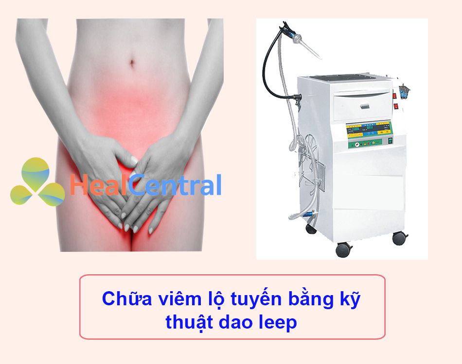 Điều trị viêm lộ tuyến bằng kỹ thuật dao leep