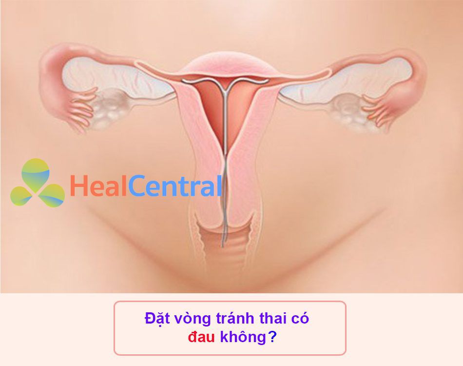 Đặt vòng tránh thai có đau không?