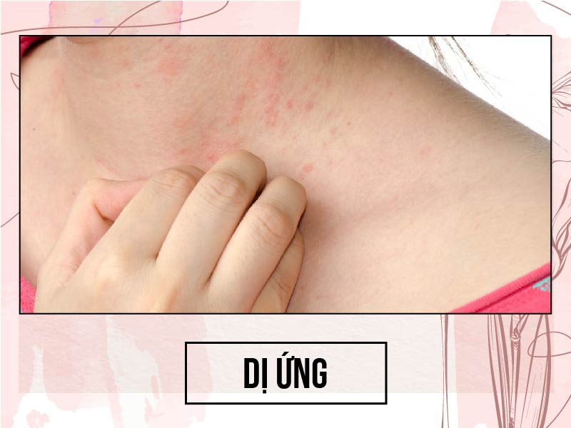 Ảnh minh họa. Dị ứng do dùng thuốc kháng sinh nhóm Carbapenem