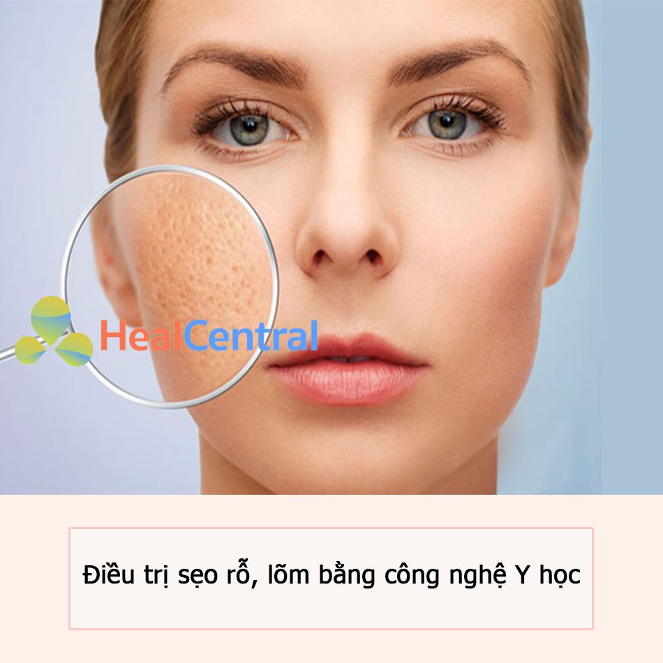 Điều trị sẹo rỗ, sẹo lõm: phương pháp, chi phí và các địa chỉ điều trị uy tín.