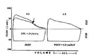 Hình 12. Các vòng lưu lượng – thể tích kiểm soát và nhịp thở thử nghiệm áp lực thở ra âm tính với áp lực cuối thì thở ra bằng không (ZEEP), cho thấy giới hạn lưu lượng thở ra (EFL) khi kết thúc thở ra. Áp dụng áp lực dương cuối kỳ thở ra nội sinh (PEEP) 6,5 cm H2O đã đảo ngược giới hạn lưu lượng thở. INSP = hít vào. EXP = thở ra. (Từ Tài liệu tham khảo 53, với sự cho phép.)