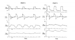 Hình 16. Áp lực đường thở (Paw), lưu lượng (V ̇), áp lực thực quản (Pes) và dạng sóng áp lực dạ dày (Pga) từ một bệnh nhân mắc bệnh phổi tắc nghẽn mạn tính, được thở máy với PEEP = 0 (bảng bên trái) và với PEEP là 5 cm H2O (bảng bên phải). Sự thay đổi thực quản thì hít vào và công thở là tối đa trong quá trình thông khí với PEEP bằng không. Hơn nữa, một nỗ lực hít vào không hiệu quả đã được xác định. Áp dụng PEEP làm giảm rõ rệt các nỗ lực hít vào, PEEP nội sinh và không đồng bộ bệnh nhân - máy thở. (Chuyển thể từ Tài liệu tham khảo 74, với sự cho phép.)