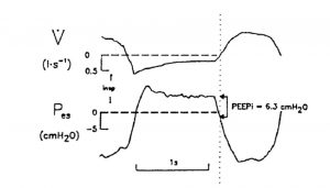 Hình 9. Dạng sóng của lưu lượng ( ̇ ) và áp lực thực quản (Pes), minh họa phương pháp xác định PEEP tự động trong quá trình thông khí tự nhiên không được hỗ trợ. Auto-PEEP được đo là độ lệch âm của Pes từ khi bắt đầu nỗ lực hít vào đến điểm không lưu lượng. (Từ Tài liệu tham khảo 38, với sự cho phép.)