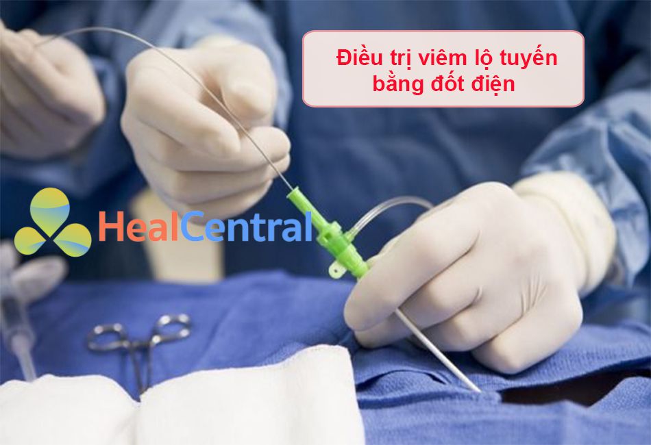 Điều trị viêm lộ tuyến bằng đốt điện