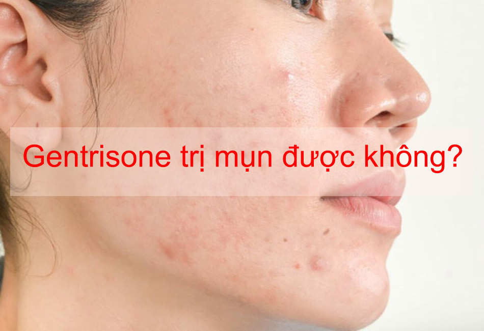 Gentrisone trị mụn được không?