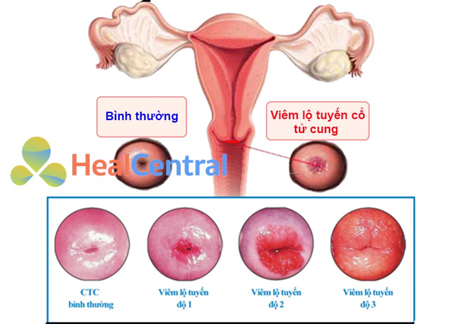 3 cấp độ của viêm lộ tuyến cổ tử cung 