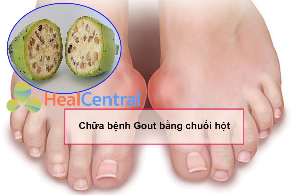 Bài thuốc Nam chữa bệnh Gout từ chuối hột