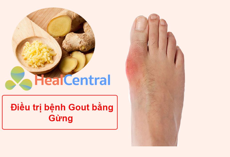 Bài thuốc Nam chữa bệnh Gout từ Gừng